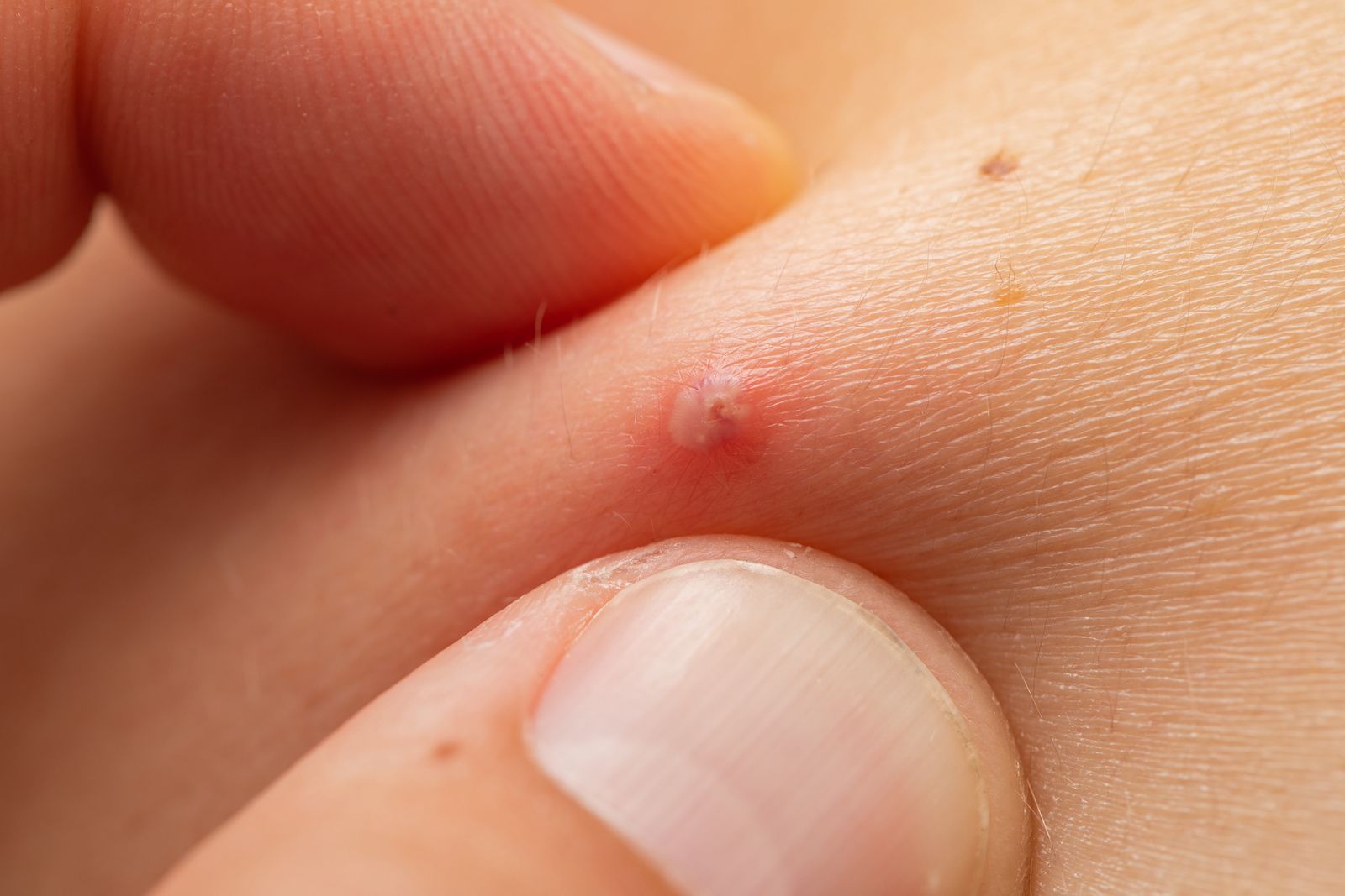 hidradenitis supurativa hidradenitis supurativa