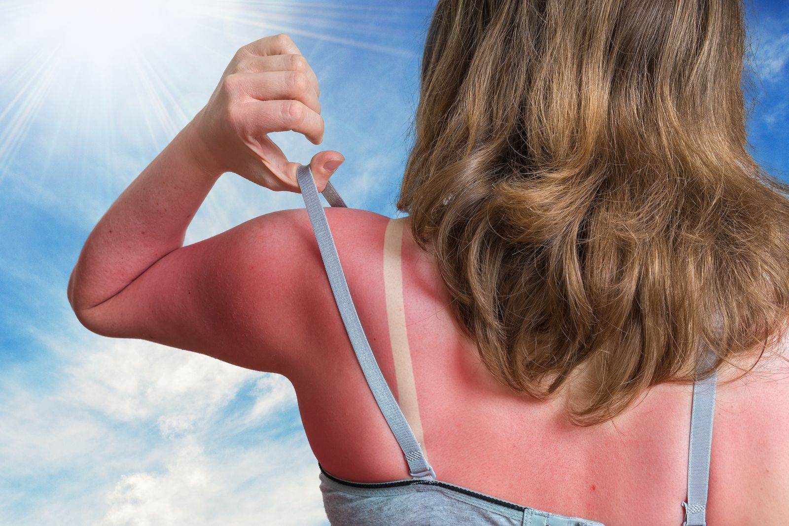 Qué medidas deben llevar a cabo las personas mayores si se queman al sol en verano