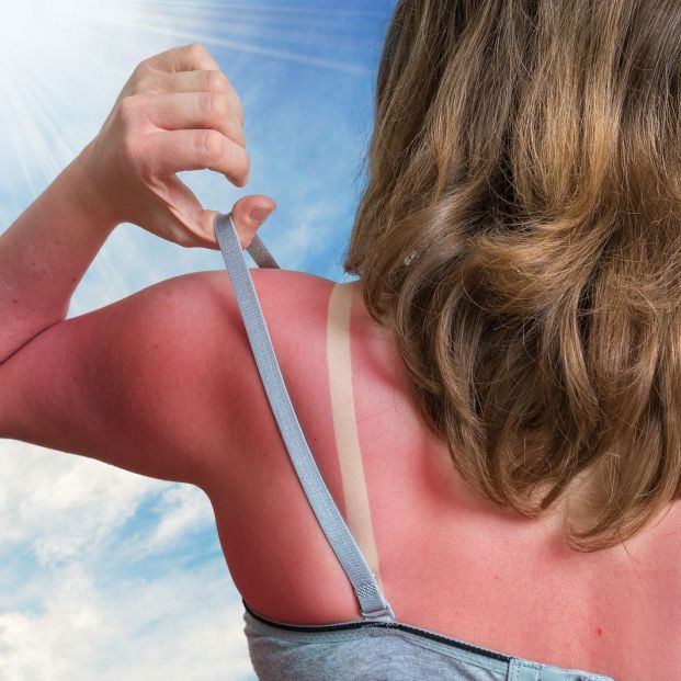 Qué medidas deben llevar a cabo las personas mayores si se queman al sol en verano