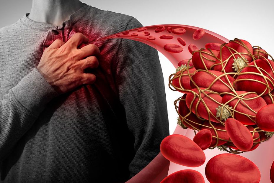 La inclinación de venas pulmonares en el corazón influye al riesgo de trombos (Big Stock) La inclinación de venas pulmonares en el corazón influye al riesgo de trombos (Big Stock)