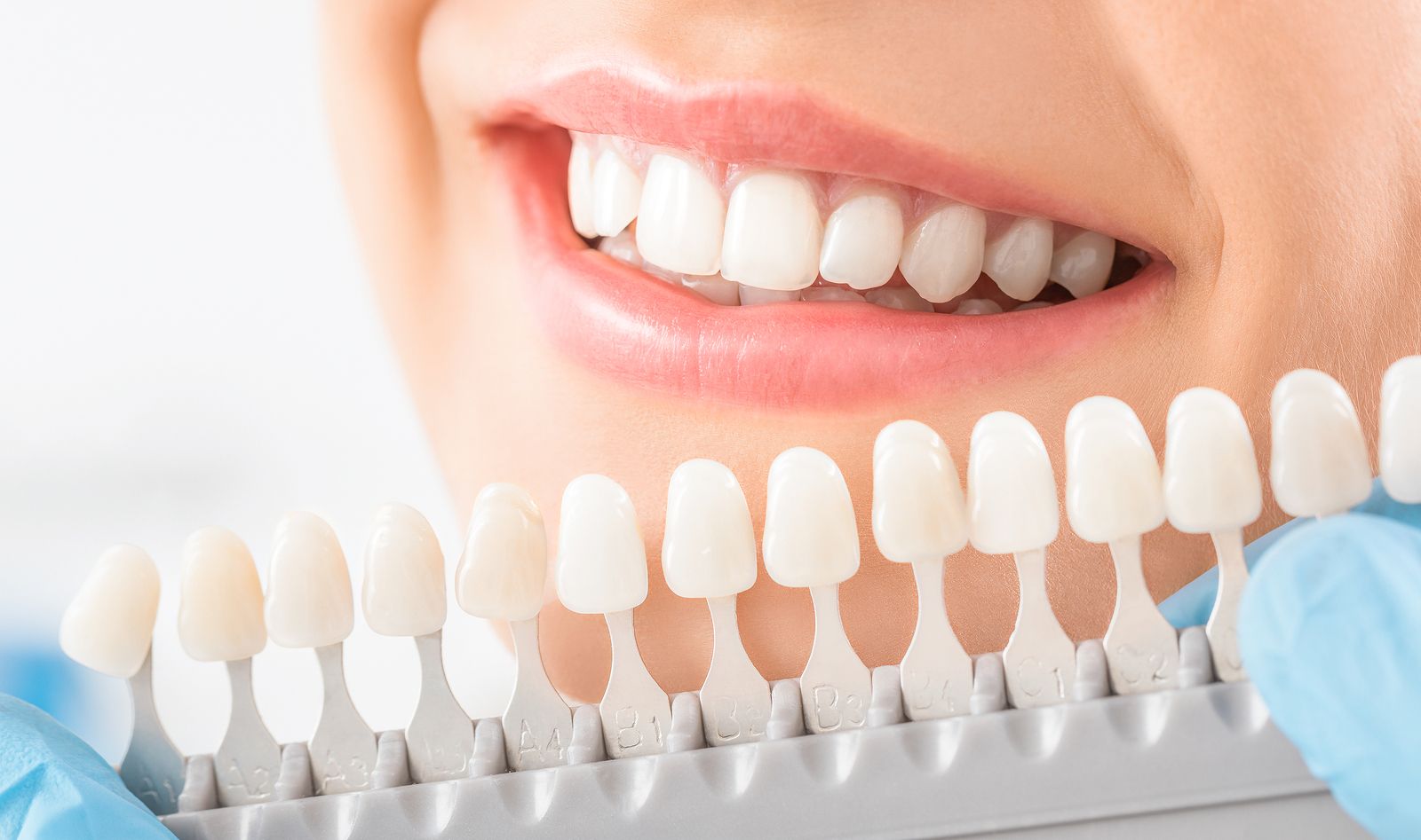En qué consiste un tratamiento de blanqueamiento dental?