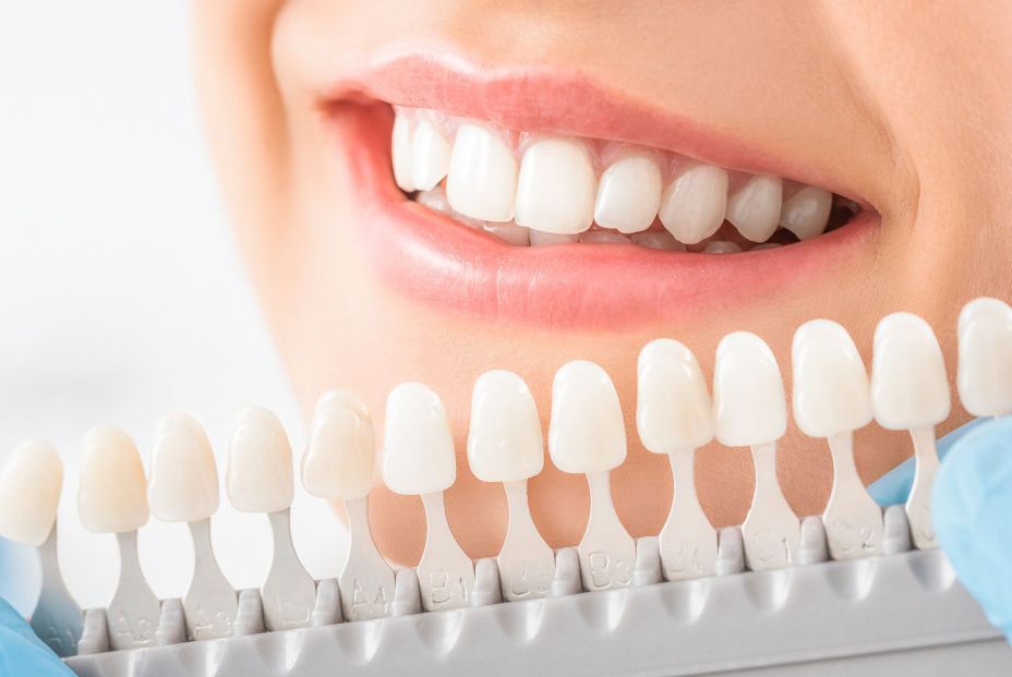 ¿En qué consiste un tratamiento de blanqueamiento dental?