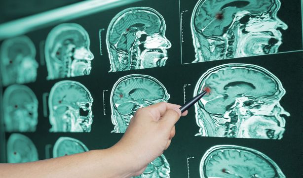¿Es posible una enfermedad de Alzheimer sin síntomas?