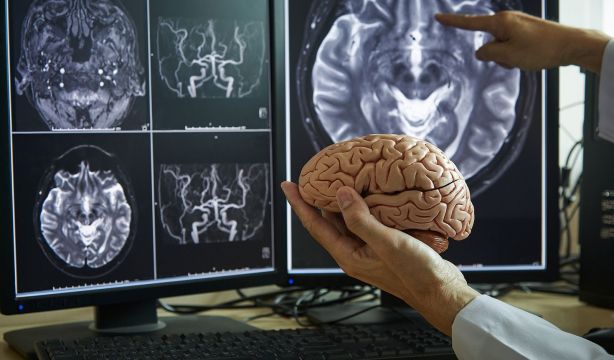 En las etapas asintomáticas del alzhéimer disminuye el flujo sanguíneo cerebral