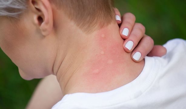 ¿Por qué me pican los mosquitos más que a otros? No es solo tu sangre (y puedes evitarlo)