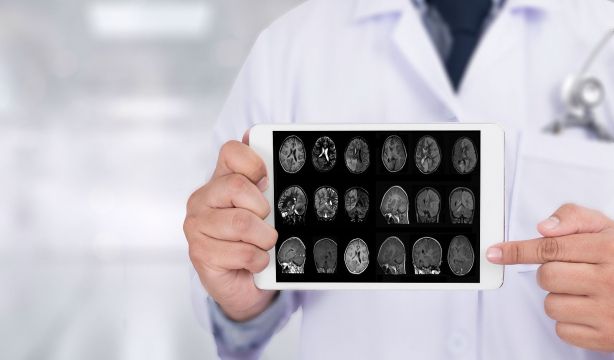 Los últimos estudios sobre el alzhéimer confirman la importancia de la detección precoz
