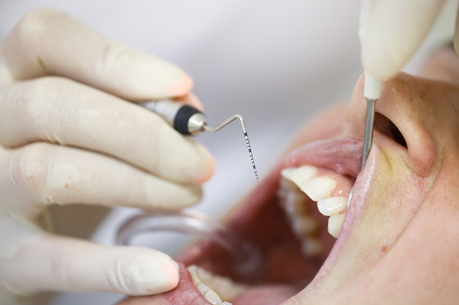 ¿Qué provoca el desgaste de encías y qué consecuencias tiene para la salud dental?