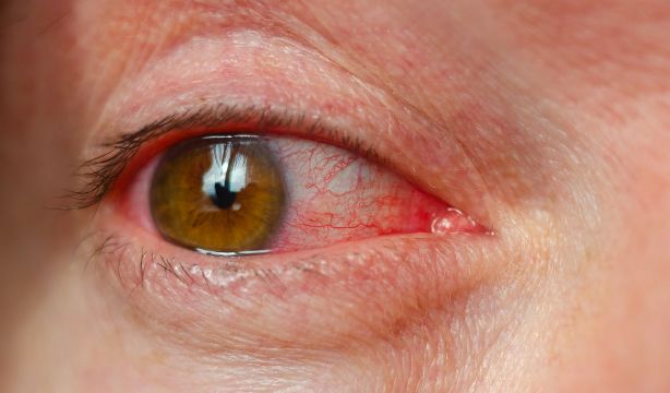 La conjuntivitis vírica se dispara en invierno: cómo tratarla y cómo evitar contagiarse