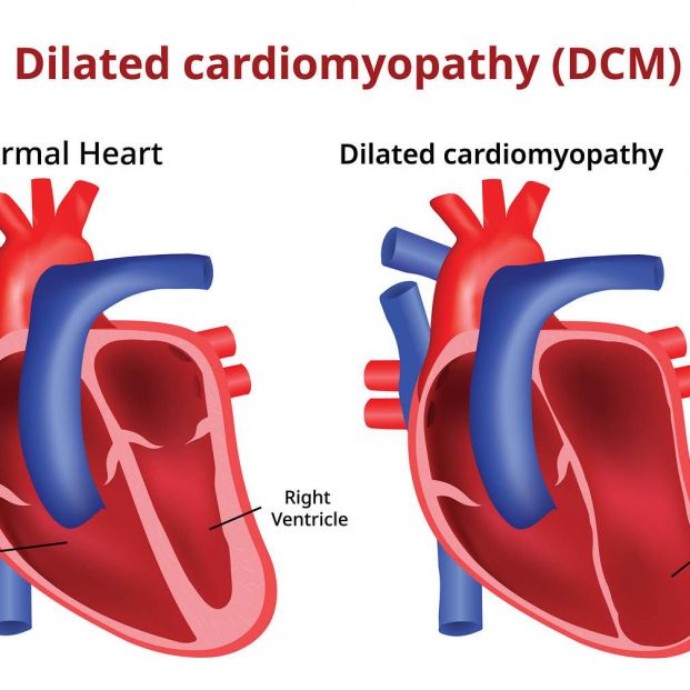 Qué es la miocardiopatía diabética y qué solución tiene