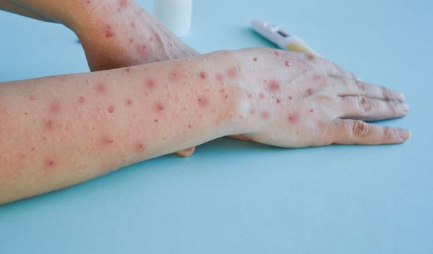 Crisis por la viruela del mono: casos en España, quién debe vacunarse y medidas por la nueva cepa