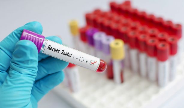 El Herpes Zóster aumenta el riesgo de deterioro cognitivo posterior