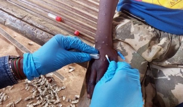 Tengo síntomas de viruela del mono: ¿debo hacer cuarentena? ¿qué medicamento tomo? ¿voy a Urgencias?
