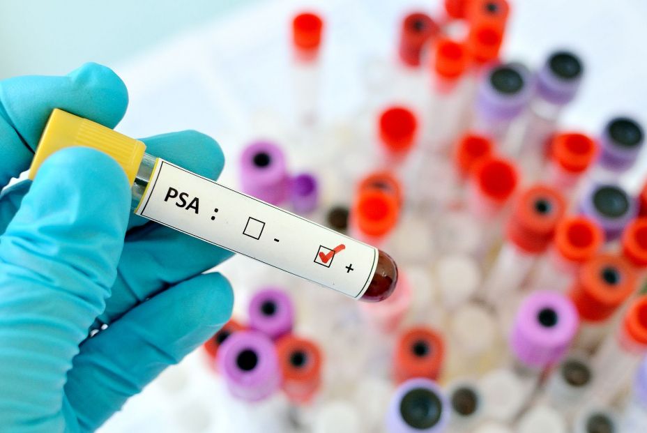 ¿Está sobrediagnosticado el cáncer de próstata? ¿Está sobrediagnosticado el cáncer de próstata?