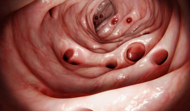 Los divertículos en el colon se incrementan con la edad: un 10% cada 10 años
