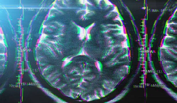 Alzhéimer: un desafío global en el cuidado de la salud cerebral