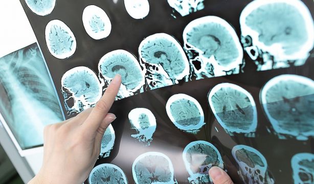 Un nuevo hallazgo podría ayudar detectar mucho antes la aparición del alzhéimer