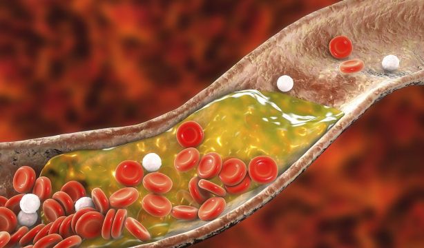 El colesterol elevado está detras del 60% de las enfermedades cardiovasculares