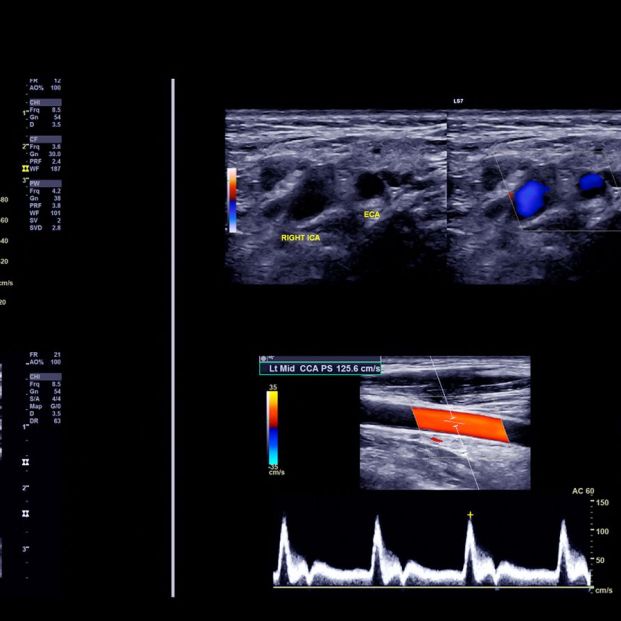 Diagnostico por imagen en urología Ecografía Doppler