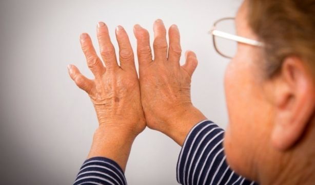 Paciente con deformación en las manos por artritis reumatoide. Fuente: Europa Press