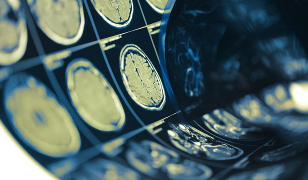 Las posibles consecuencias a largo plazo de las lesiones cerebrales traumática