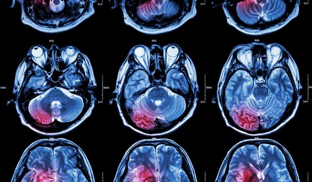 Una nueva guía para prevenir un primer ictus establece que es posible lograrlo
