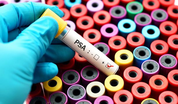 ¿Exceso de terapia en los mayores con cáncer de próstata? BigStox