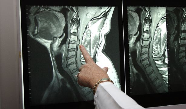 Un especialista señala una hernia en una prueba de Resonancia Magnética. Bigstock 