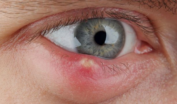 ¿Por qué aparecen los orzuelos? ¿Son contagiosos? Un médico desmiente mitos