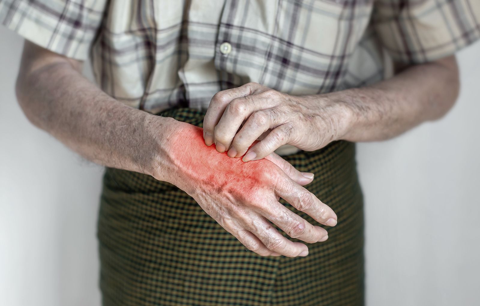 Detectan un brote de sarna en una residencia de mayores gallega que afecta a cerca de 20 personas