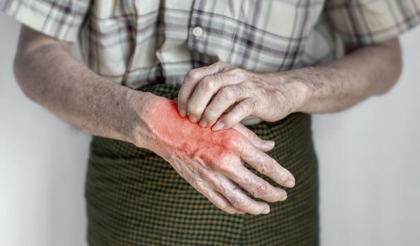 Los casos de sarna en España se disparan y afectan especialmente a los mayores de 74 años