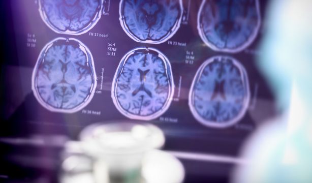 La patología de cuerpos de Lewy acelera el deterioro neurológico en el alzhéimer