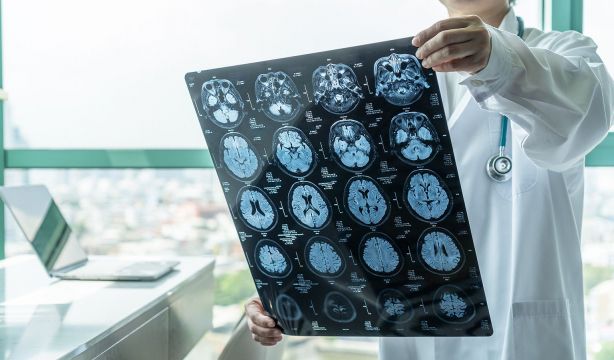 La edad es el principal factor de riesgo para padecer linfoma cerebral