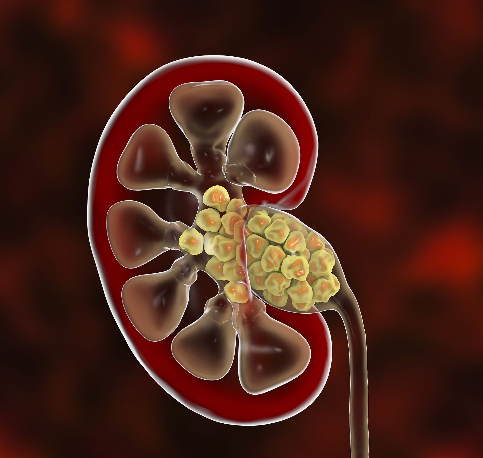 Sabes cómo se forman los cálculos renales