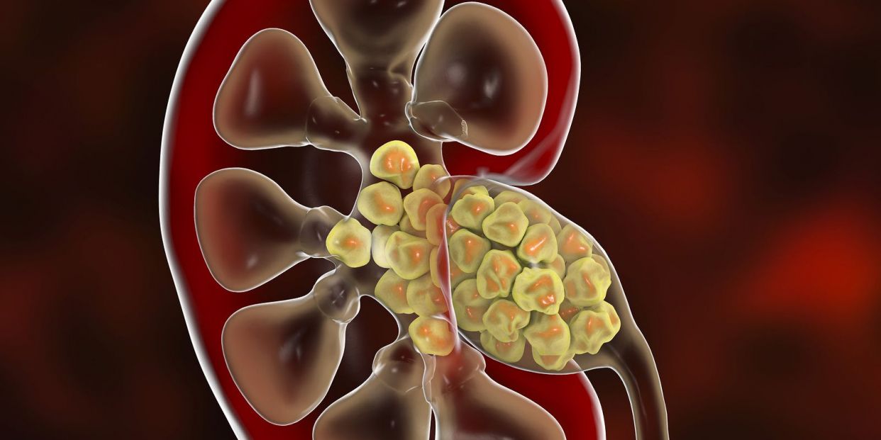 ¿Sabes cómo y por qué se forman los cálculos renales?