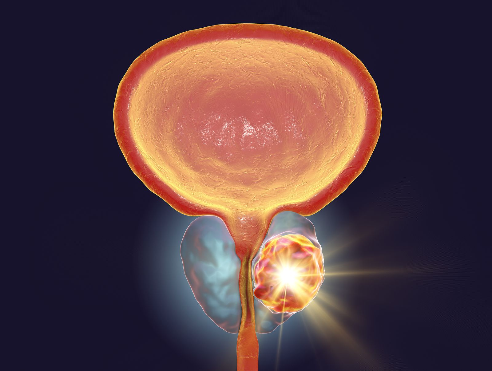 Cáncer de próstata y prostatitis: ¿en qué se diferencian?