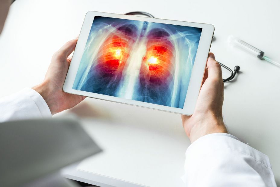 Desarrollan una estrategia eficaz contra el cáncer de pulmón más agresivo en animales