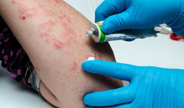 Esta es la alimentación que mejora la psoriasis. Bigstock 