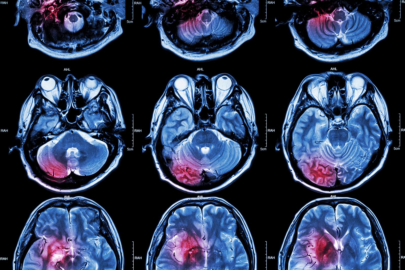 Astuce denuncia que pacientes con glioblastoma "luchan contrarreloj por recibir un tratamiento" Astuce denuncia que pacientes con glioblastoma "luchan contrarreloj por recibir un tratamiento"