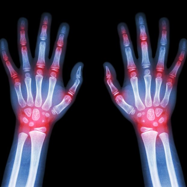 bigstock Rheumatoid Arthritis Gout Ar 103755428 bigstock Rheumatoid Arthritis Gout Ar 103755428