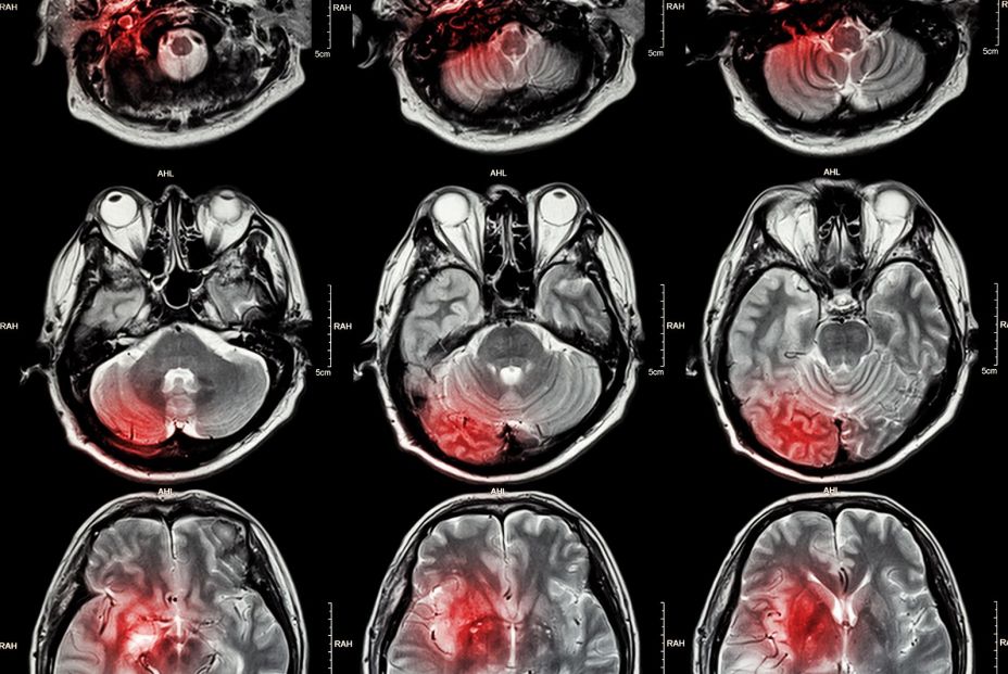 Imágenes cerebrales de lesiones. Bigstock Imágenes cerebrales de lesiones. Bigstock