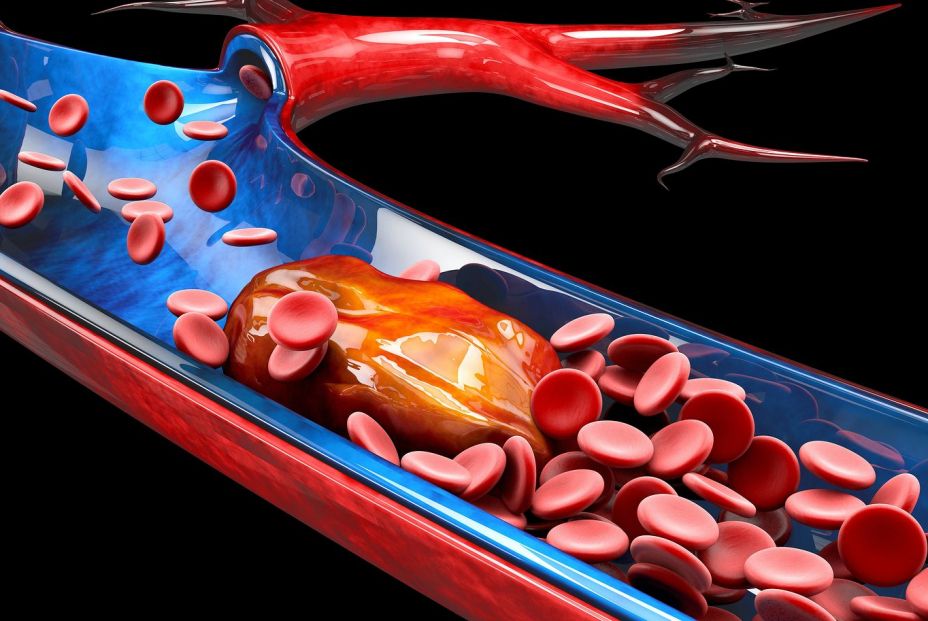 Trombosis y enfermedad oncológica Trombosis y enfermedad oncológica