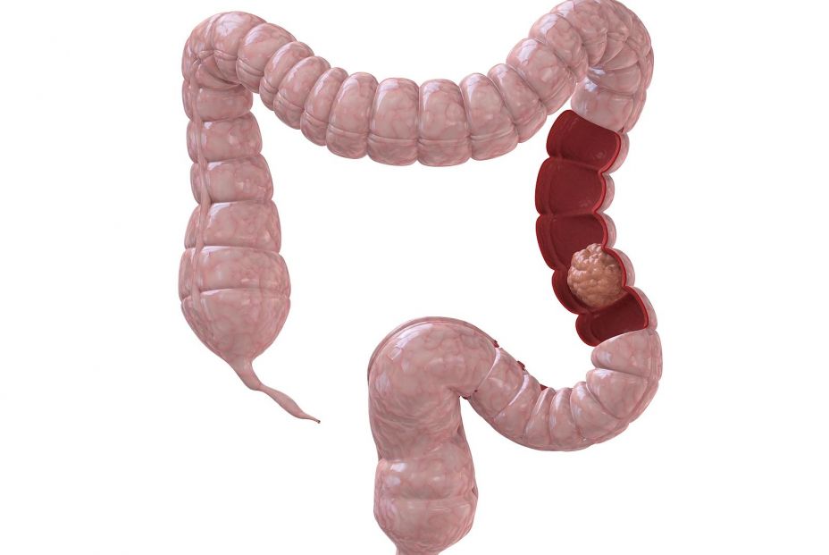 bigstock Colon Cancer 3192205