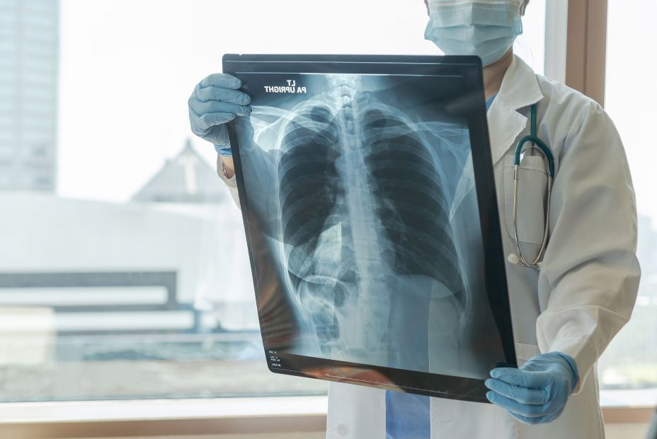 Avances contra el cáncer de pulmón: identifican una proteína como diana terapéutica