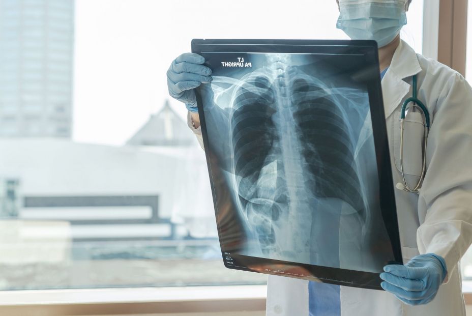 Avances contra el cáncer de pulmón: identifican una proteína como diana terapéutica