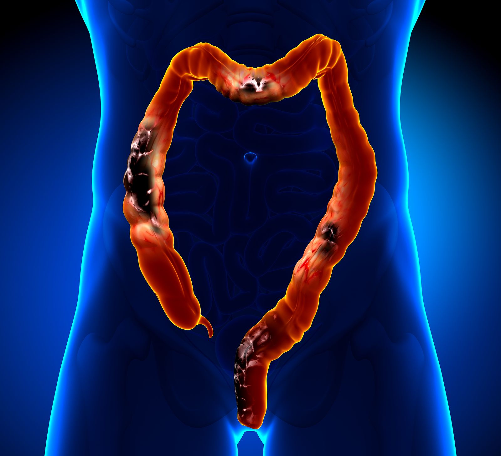 bigstock Colon Cancer Colorectal canc 59883752 bigstock Colon Cancer Colorectal canc 59883752