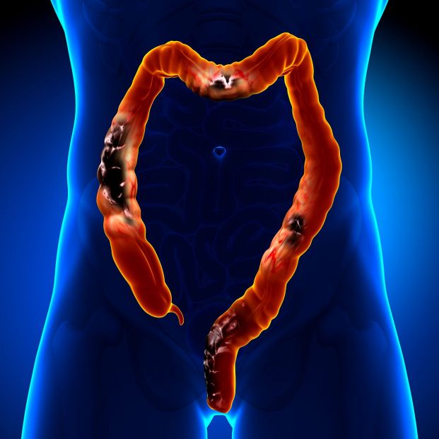 bigstock Colon Cancer Colorectal canc 59883752 bigstock Colon Cancer Colorectal canc 59883752