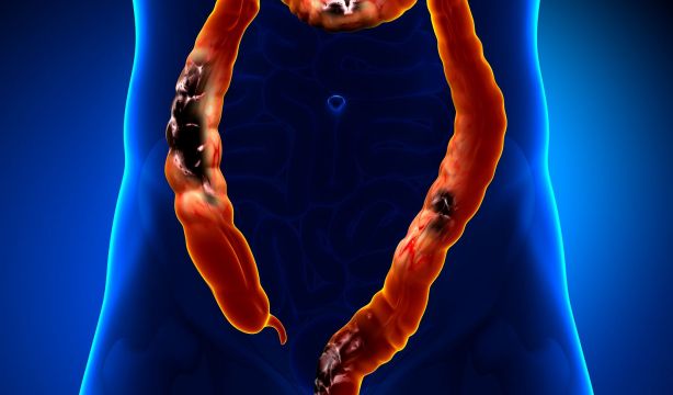 La periodontitis podría aumentar el riesgo de cáncer colorrectal, según un estudio