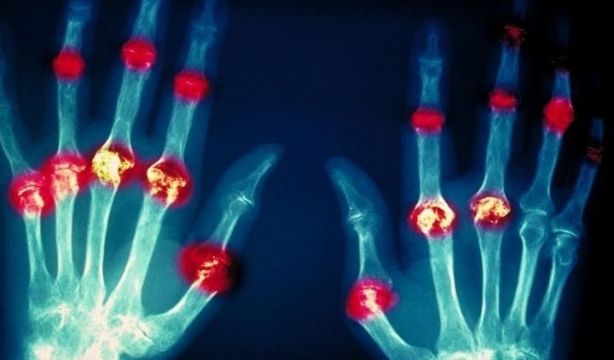 EuropaPress. La medicina regenerativa puede ser la clave para curar la artritis reumatoide