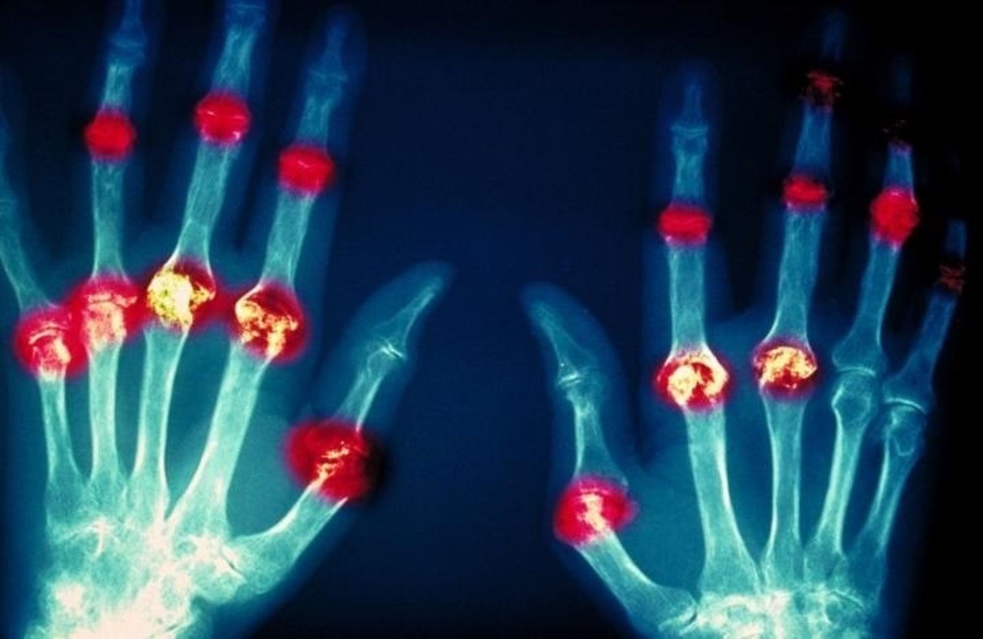 La medicina regenerativa puede ser la clave para curar la artritis reumatoide: todos los detalles La medicina regenerativa puede ser la clave para curar la artritis reumatoide: todos los detalles