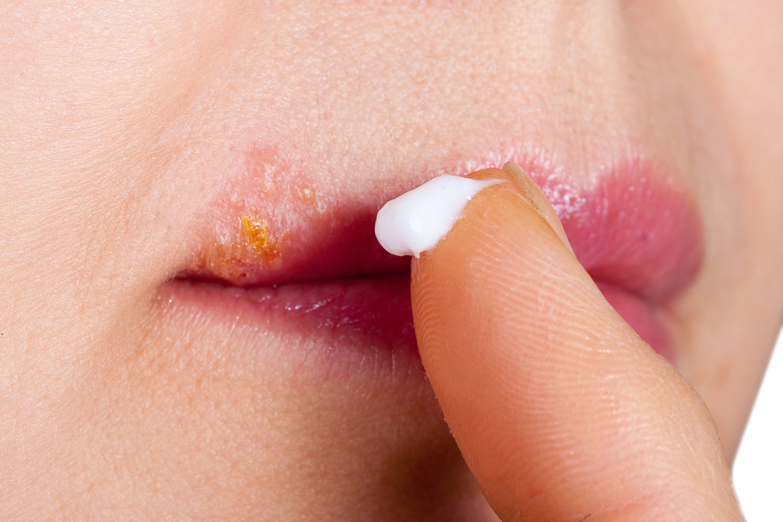 El herpes labial podría estar implicado en el desarrollo del alzhéimer. Bigstock El herpes labial podría estar implicado en el desarrollo del alzhéimer. Bigstock